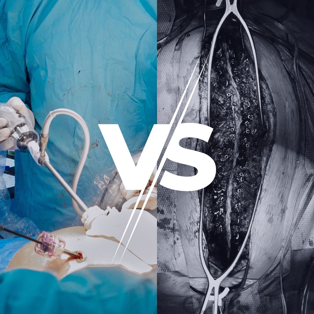 Minimally Invasive vs Open Spine Surgery in London