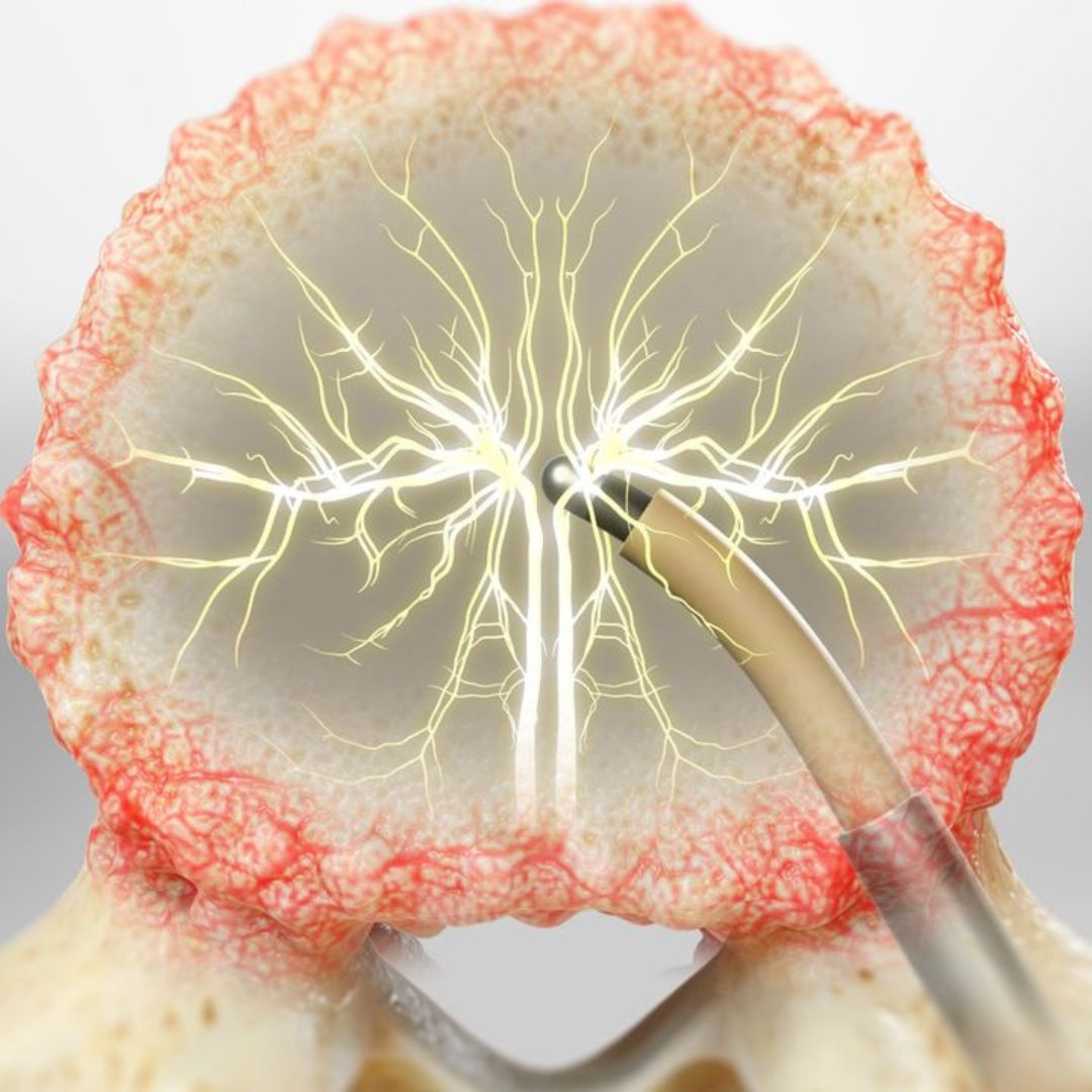 Basivertebral Nerve Ablation (BVNA) | London Spine Health