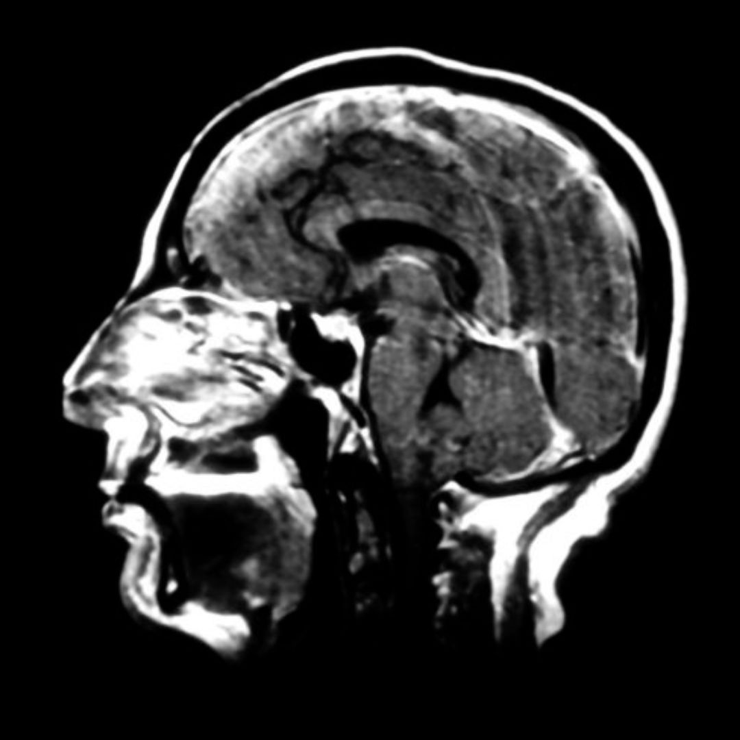 Spontaneous Intracranial Hypotension