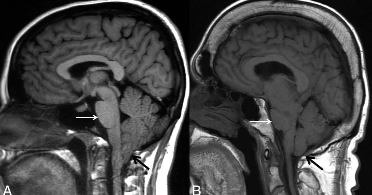 Spontaneous Intracranial Hypotension London Spine Health 2 (1)