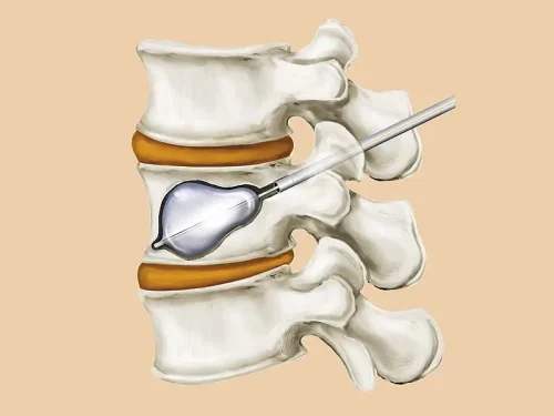 Balloon-Kyphoplasty - London Spine Health