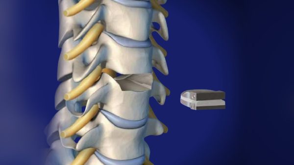 Disc Replacement Surgery