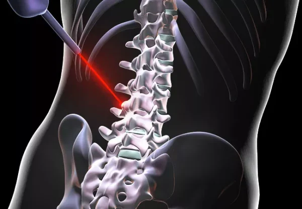 Laser Spine Surgery - MSpine