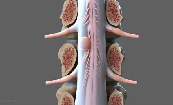 Spinal Tumor Surgery