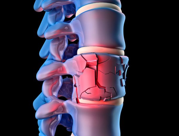 Spine Trauma Treatment - MSpine